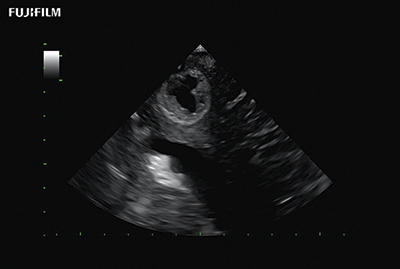 Burr Hole Procedure using S31KP