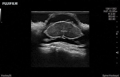 Spinal Procedure using L53K
