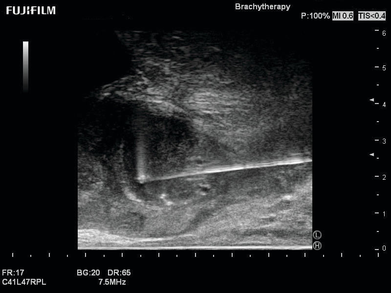 Transperineal Biopsy using the C41L47RP Transducer
