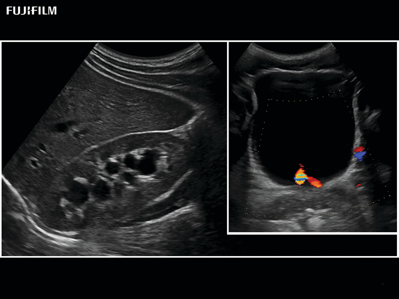 Kidney and Bladder Imaging using C253A Transducer